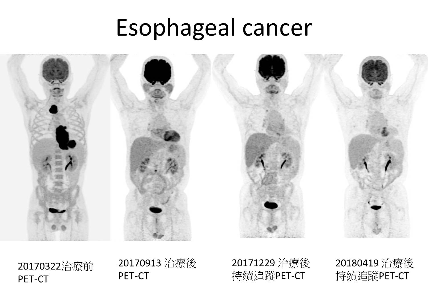 食道癌.jpg
