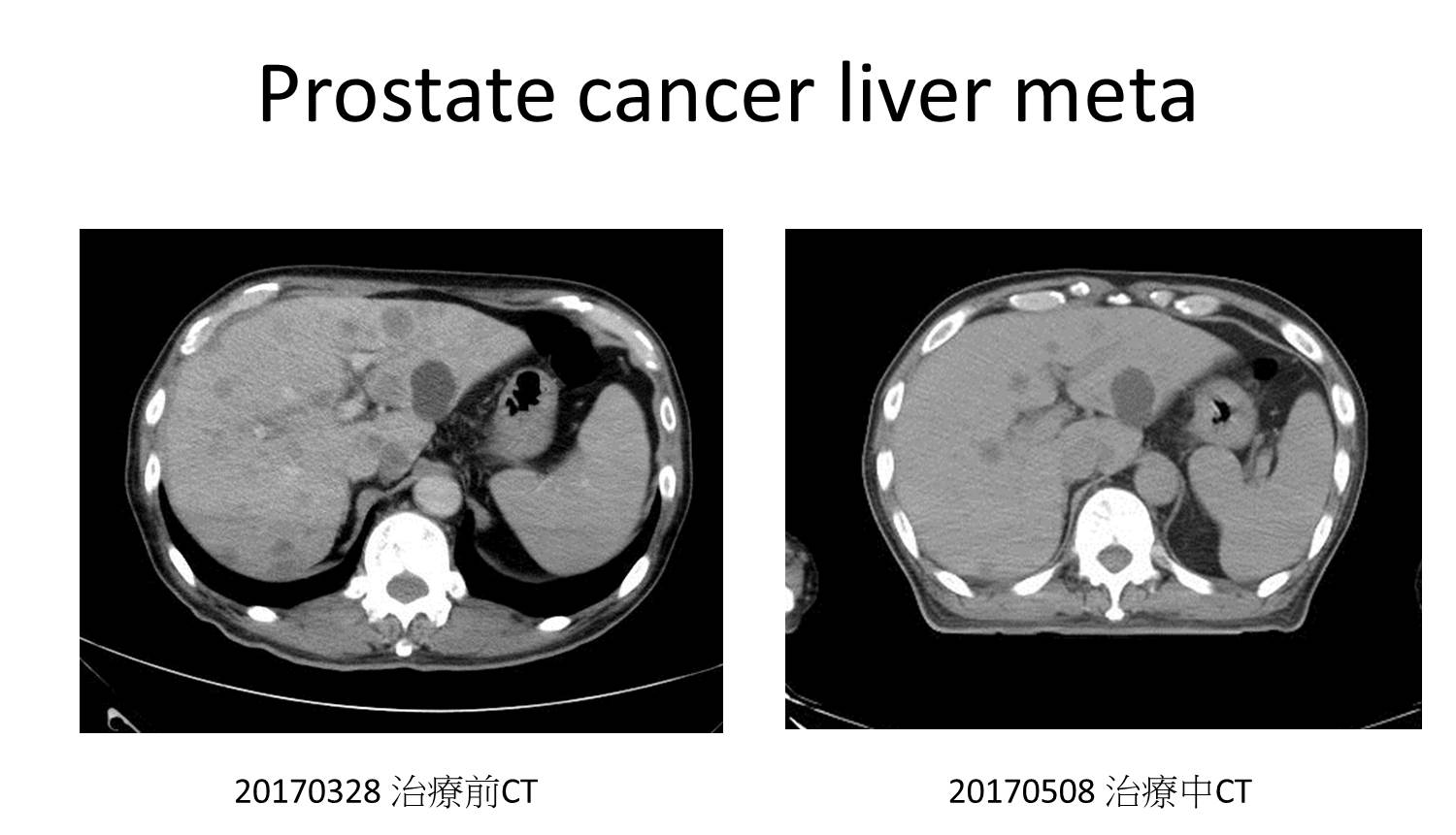 攝護腺癌肝轉移.jpg